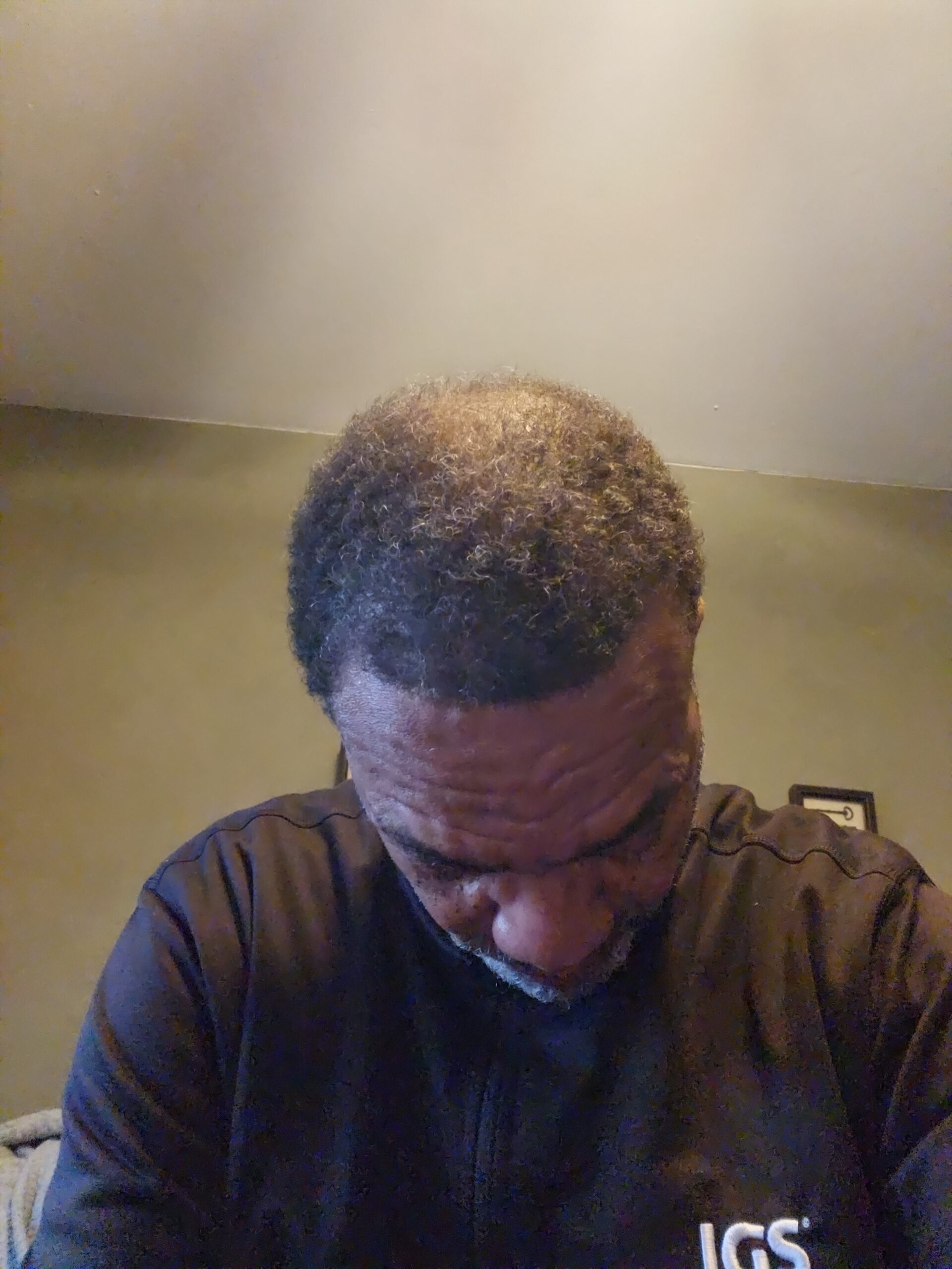 Starting point photo showing thinning crown area before hair growth test